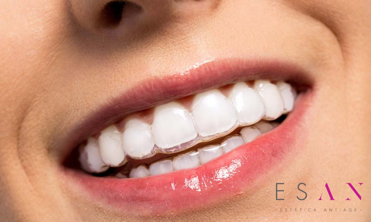 Cómo saber si la ortodoncia Invisalign es adecuada para mí – Clínica ESAN