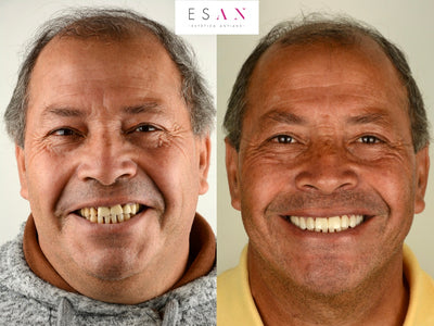 Carillas, los pro y contras de la sonrisa perfecta.