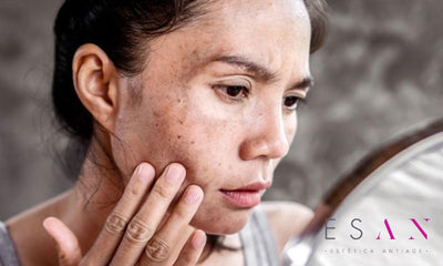 ¿Por qué tengo manchas en la cara? ¿Qué hacer cuando aparecen?