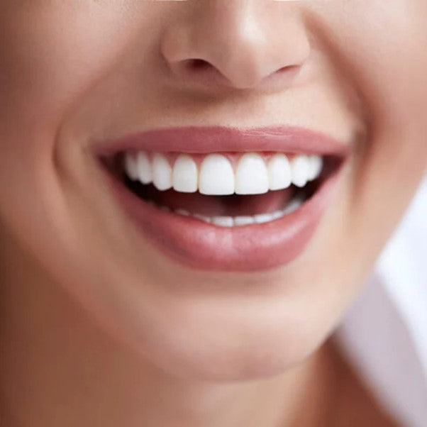 Blanqueamiento Dental Laser