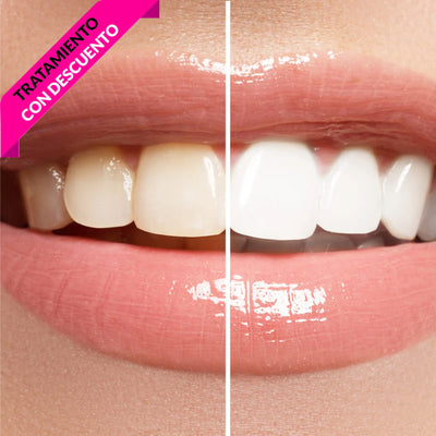 Blanqueamiento Dental Laser