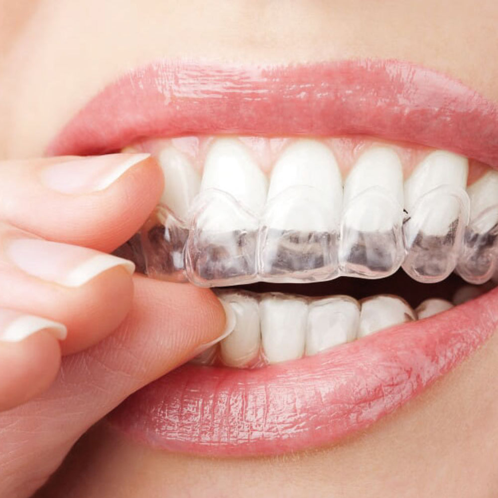 frenillos-invisibles-invisalign-clinica-esan-estetica-dental-1