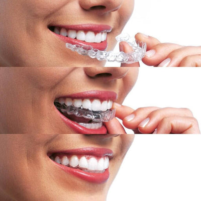 frenillos-invisibles-invisalign-clinica-esan-estetica-dental-2