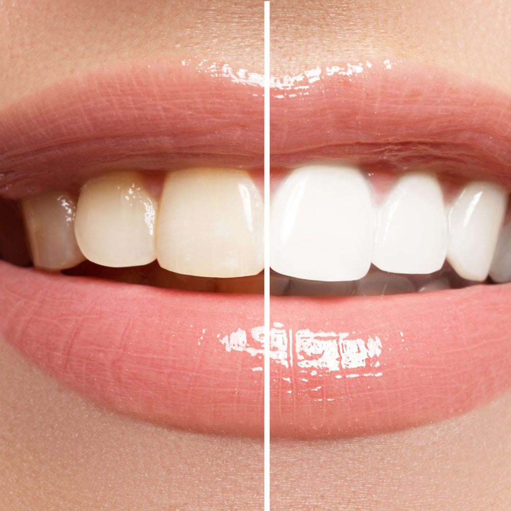 blanqueamiento-dental-laser-clinica-esan-estetica-dental-1