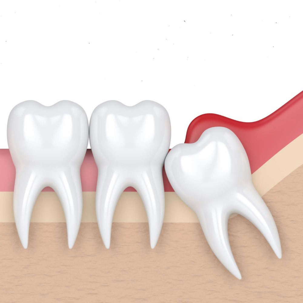 Extraccion-molar-del-juicio-clinica-esan-odontologia-especializada-1