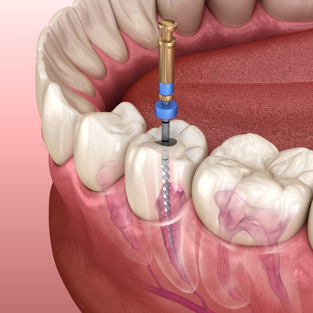 Endodoncia