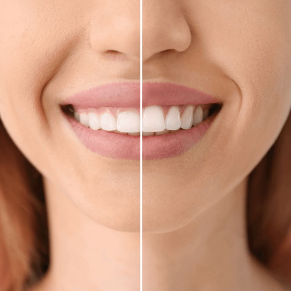 Gingivectomía