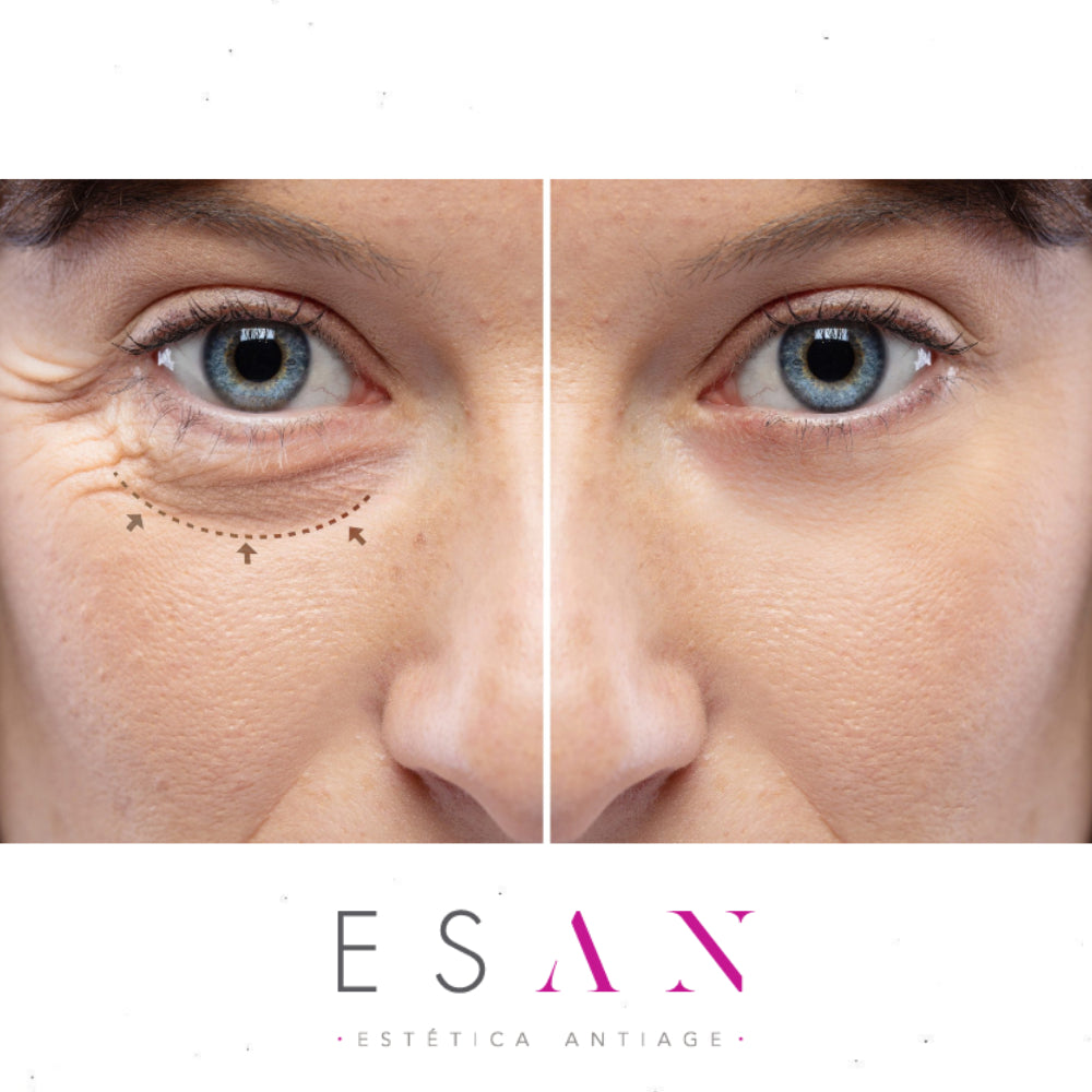 Blefaroplasma-clinica-esan-estetica-facial-3